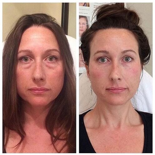 Fille avant et après le rajeunissement du visage avec laser