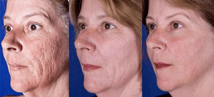 Résultat après la procédure de rajeunissement de la peau du visage avec le laser